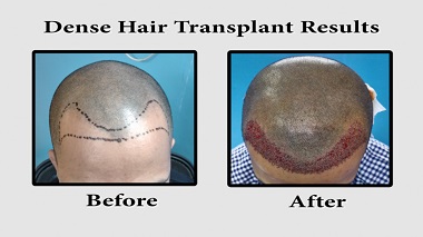 Best hair transplant in hyderabad
