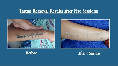 Tattoo Removal in Hyderabad